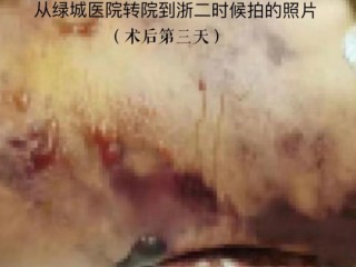 网红小冉抽脂感染图片,网红小冉抽脂感染
