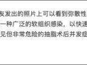 坏死性筋膜炎网红小冉,网红小冉抽脂感染坏死性筋膜炎