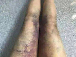 抽脂死亡的网红小冉(抽脂死亡小冉照片)